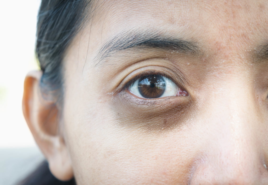 Dark Circles Under The Eyes Why We Have Them And How To Treat Them Chrysalis Clinic Ottawa