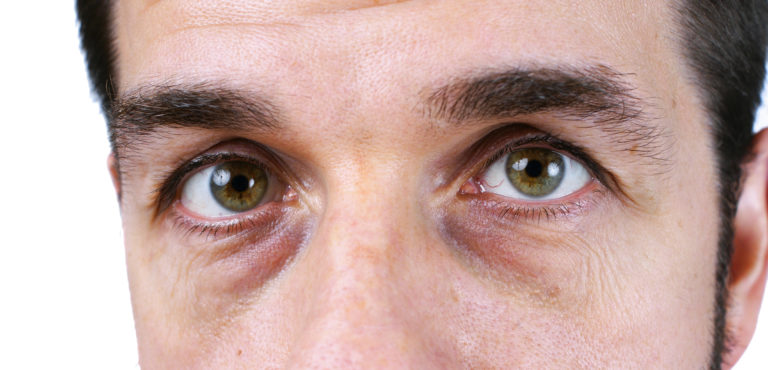 dark-circles-under-the-eyes-why-we-have-them-and-how-to-treat-them